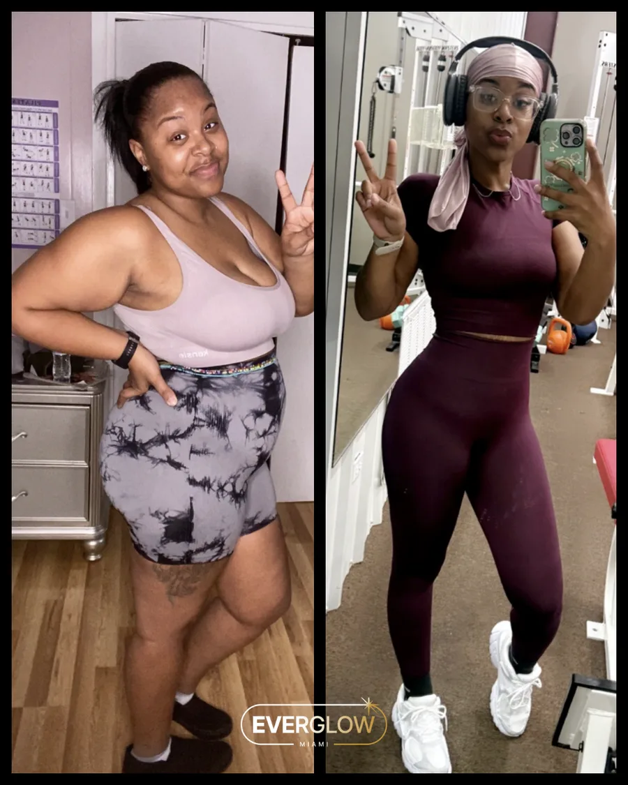 Everglow Miami patient before and after weight loss transformation