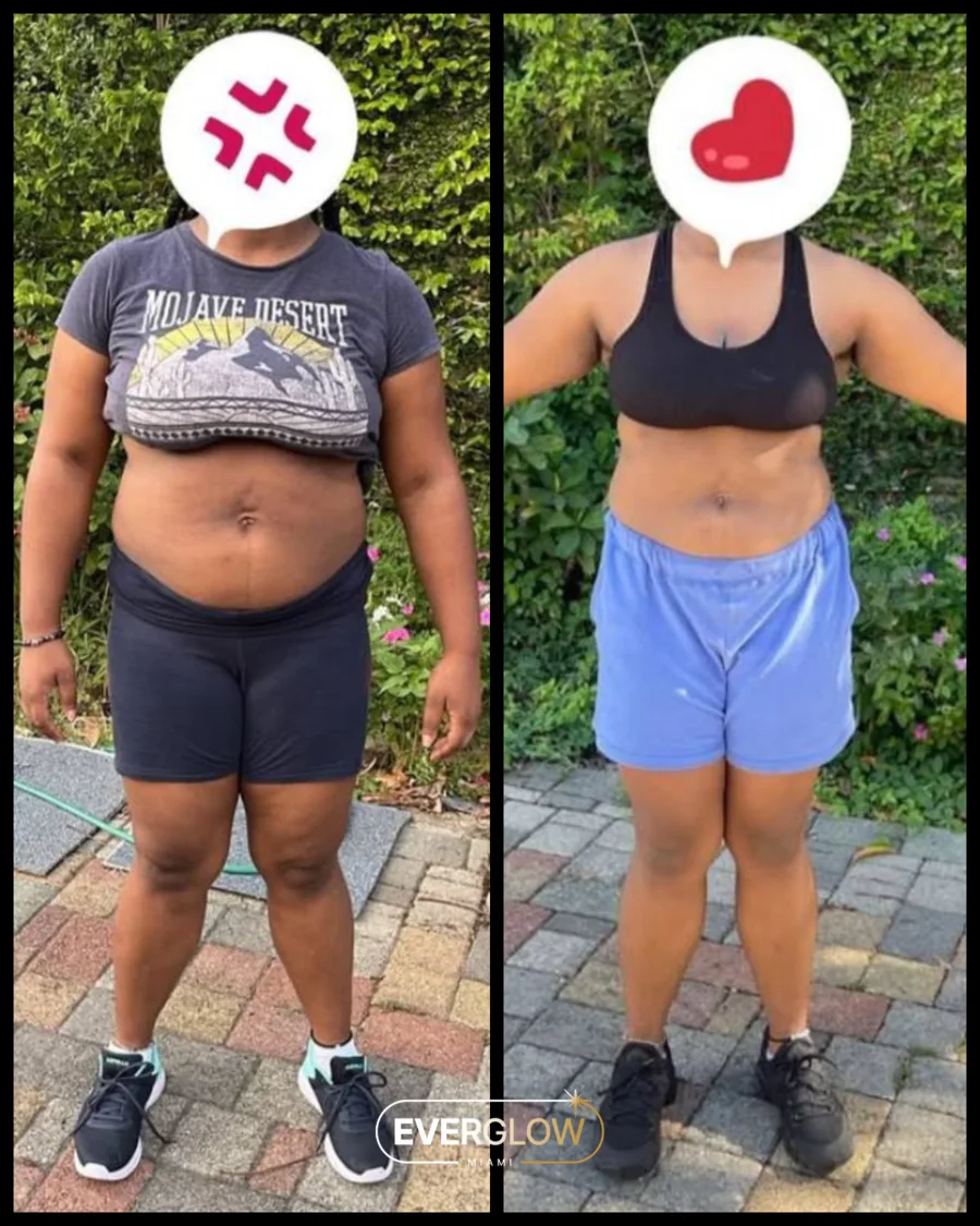 Everglow Miami patient before and after weight loss transformation