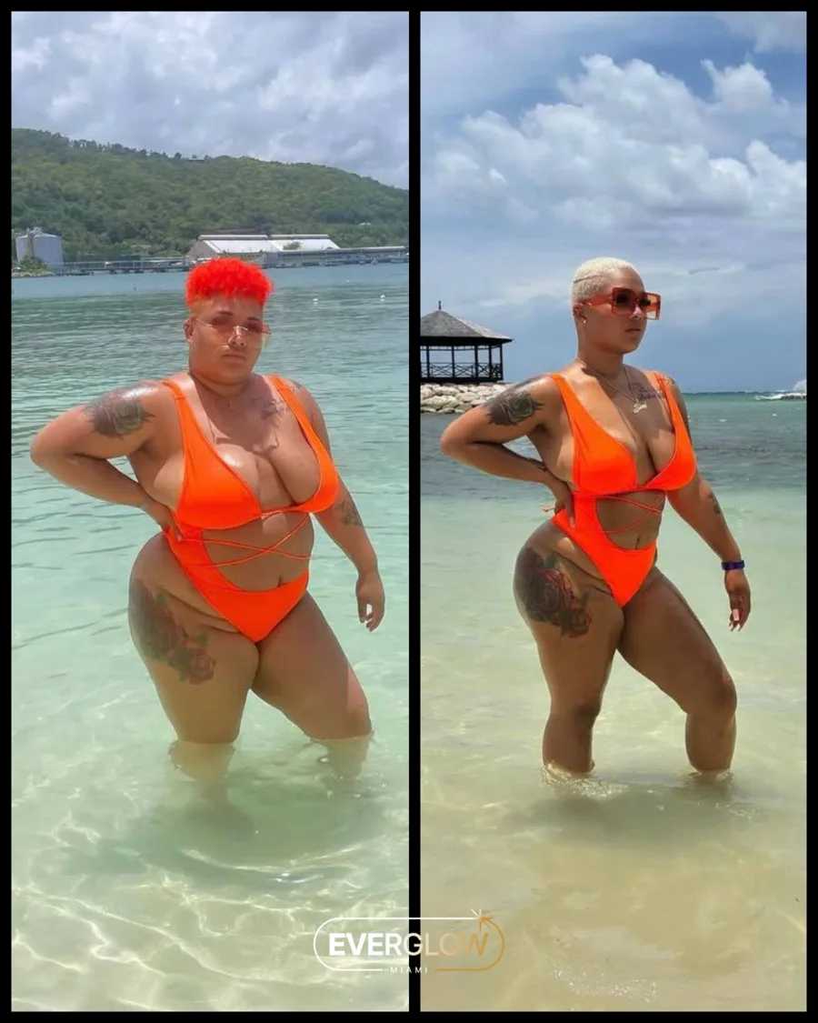 Everglow Miami patient before and after weight loss transformation