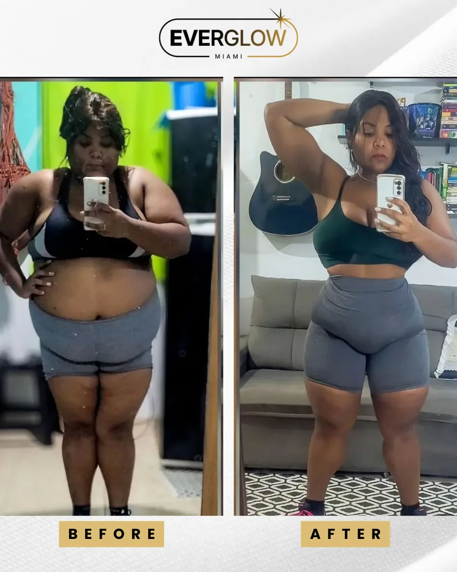 Everglow Miami patient before and after weight loss transformation