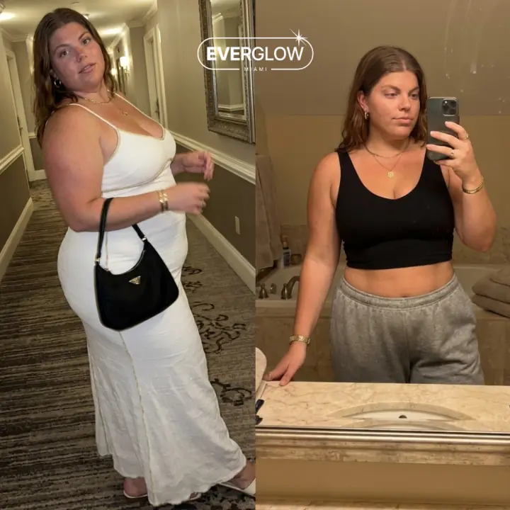 Everglow Miami patient before and after